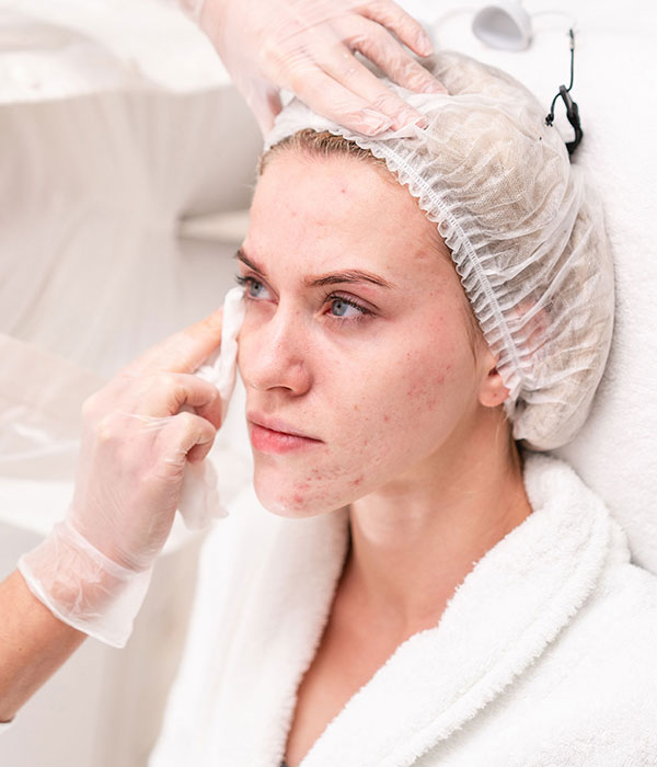 Woman getting acne facial
